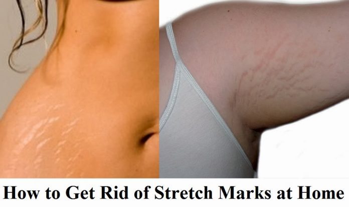 How to Get Rid of Stretch Marks at Home