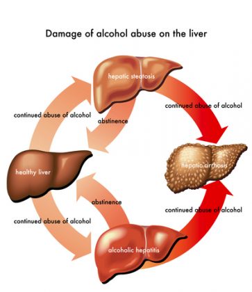 cirrhosis-liver-from-alcohol-abuse
