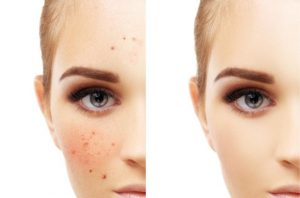 5 ways using tea tree oil acne 1024x1024 768x507